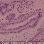 Ovary cancer serous papillary cystadenoma
