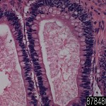 Ovary mucinous adenocarcinoma