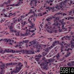 Pancreas adenocarcinoma