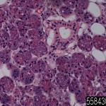 Parotid gland mucoepidermoid carcinoma