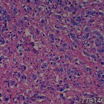 Prostate adenocarcinoma Gleason's Score 9