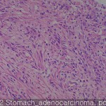Stomach cancer adenocarcinoma 02