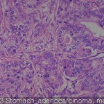 Stomach cancer adenocarcinoma 03