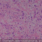 Stomach cancer adenocarcinoma