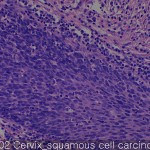 Uterine cervix cancer-metastasis-normal squamous cell cercinoma 02