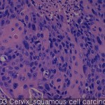 Uterine cervix cancer-metastasis-normal squamous cell cercinoma 03