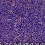Uterine cervix cancer-metastasis-normal squamous cell cercinoma