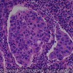 Various cancers Breast infiltrating duct carcinoma