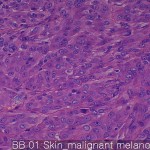 Various cancers Skin Malignant