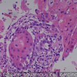 Various cancers Skin Squamous call carcinoma