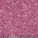 Various cancers parotid gland acinic cell carcinoma