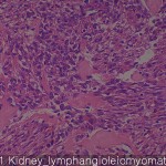 Various sarcomas kidney