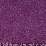 Various sarcomas soft tissue 02