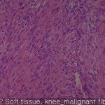 Various sarcomas soft tissue
